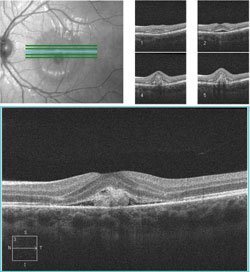 A solid elevation in the subretinal space and subretinal fluid consistent with a presumed choroidal neovascular membrane in the left eye