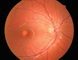 Follow-up fundus exam after an anti-VEGF injection in the left eye.