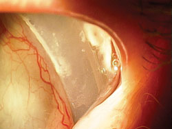 Scleral buckle repair