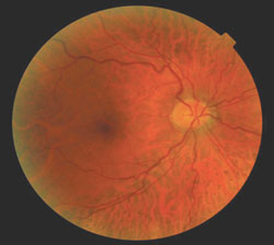 The examination of the posterior segment and periphery of the right eye was unremarkable. 