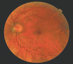 The posterior segment and periphery of the left eye had an elevated bullous lesion in the peripheral fundus.