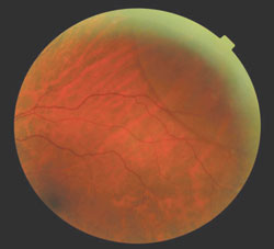 The posterior segment and periphery of the left eye had an elevated bullous lesion in the peripheral fundus.