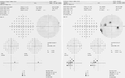 Automated bowl visual fields in this 50-year-old showed nerve fiber bundle defect and inferior nasal step in the right eye and only one small defect in the left eye (which is superior and matches the light blue inferior river).