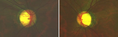 This 46-year-old female was a glaucoma suspect because her sister and daughter had ocular hypertension. Her IOPs were 29 mm Hg OS. Pupils were 4 mm, round and 4+ reactive, with negative afferent pupillary defect. Cupping was 0.9 V x 0.65 H cup OD and 0.8 V x 0.65 H OS shallow excavations viewed with the Digital High Mag lens. Large optic disc cupping (pallor OS greater than OD) could be seen with Panoramic 200C images.