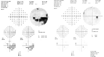 This patient's automated bowl visual fields show mild central defects in the right eye. The left eye shows an inferior nerve fiber bundle defect that agrees with the superior broad blue to gray river and milder superior defects that match the less developed inferior blue river.