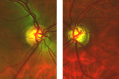 This 46-year-old male was a glaucoma suspect due to high IOPs of 23 mm Hg OD and 35 mm Hg OS. Visual acuity is 20/50 (20/20 with pinhole) OD and 20/40 (20/80 with pinhole) OS. Pupils were 3.5 mm, round and 4+ reactive in the right eye and 1+ to 2+ reactive in the left eye with 2+ afferent pupillary defect. Cupping was 0.35 OD and 0.9 OS viewed with the Digital High Mag lens. Asymmetric cupping was greater in the left eye than the right as viewed by Panoramic 200C images.