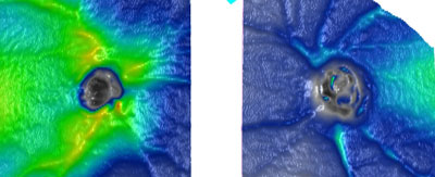 This patient's right eye has a lot of green grassland (except for a small area of blue inferior), and the left eye has lost most of the green grassland (except for a temporal island of light green).