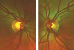 This 62-year-old female was sent in for evaluation due to large optic disc cupping. Her visual acuity was 20/25 (20/20 with pinhole) OD and 20/20- (20/20 with pinhole) OS. Her IOPs were 22 mm Hg OD and 23 mm Hg OS. Her pupils were 3.5 mm, round, 4+ reactive, with no afferent pupillary defect. She had cupping of 0.45 OD and 0.2 OS as viewed with the Digital High Mag lens (Volk). She had asymmetric optic disc sizes with optic disc cupping OD greater than OS as shown by Panoramic 200C images (Optos). 