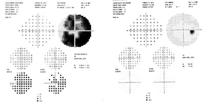 The automated bowl visual fields showed a marked constriction in the left eye; the right eye is without defects.