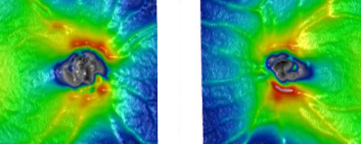 A significant amount of retinal nerve fiber layer (RNFL) in this patient is represented as green grass lands, as shown with the Cirrus HD-OCT (Carl Zeiss Meditec). Yellow to red areas around the disc are caused by elevation of the nerve fiber layer due to underlying blood vessels.