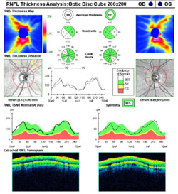 RNFL scans show retinal nerve fiber thickness in the green and white with a high degree of symmetry, at 91%.