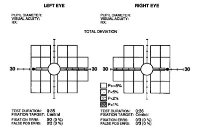 A Matrix N-30-5 FDT screening test in this 62-year-old female showed no defects.