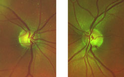 A 50-year-old female was sent in for evaluation due to large optic disc cupping. Her visual acuity was 20/25 OD and 20/20 OS. IOP was 20 mm Hg OD and 22 mm Hg OS. Her pupils were 4 mm OD and 4.25 mm OS, round and 4+ reactive with no afferent pupillary defect. Cupping was 0.7 V x 0.35 H cup OD and 0.4 V x 0.35 H cup OS with a disc margin heme inferior temporal in the left disc as viewed with the Digital High Mag lens. Asymmetric cupping was OD greater than OS with a Drance disc margin hemorrhage at 5 o'clock on the left disc as shown with Panoramic 200C images.