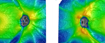 This patient's OCT showed green grass lands with inferior temporal blue river and an early superior temporal light blue river distal in the right eye with dark blue and an inferior temporal light blue in the left eye. The left disc shows a small inferior notch of the cup. Orange elevations are caused by blood vessels in the nerve fiber layer around the discs.