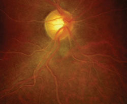 Optic nerve, arteries and veins of the right and left eyes.