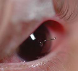 Corneal penetration