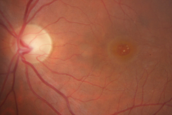 Spontaneous macular hole 1