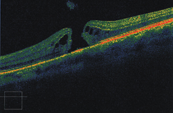 Spontaneous macular hole 2