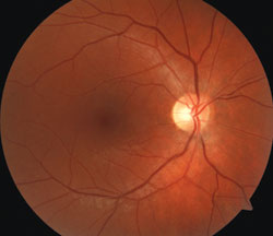 Dilated fundus exam was normal in the right eye;  the disc was flat and perfuse with a 0.3 cup-to-disc ratio and spontaneous venous pulse.