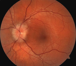 The left fundus revealed a swollen disc grade 2 with a 0.15 cup-to-disc ratio and no venous pulse.