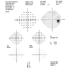 Her visual field in the left eye (right) improved to a mean deviation of -4.07 and still showed a nerve bundle fiber defect.