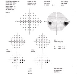 Her visual field in the left eye (right) improved to a mean deviation of -4.07 and still showed a nerve bundle fiber defect.