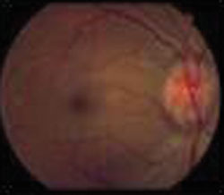 The dilated fundus exam showed the right eye with 0.1 and 3+ disc edema and hyperemia in both eyes.