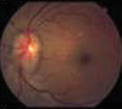 The dilated fundus exam showed the right eye with 0.1 and 3+ disc edema and hyperemia in both eyes.