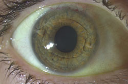 Verisyse lens. The Verisyse lens is visible in front of the iris in this undilated patient. The Verisyse lens has two haptics that clip onto a knuckle of peripheral iris. Because the lens is clipped to the peripheral iris, the patient can be dilated widely to allow for fundus examination. The lens is not foldable and must be inserted through a 6-mm incision. The suture closing the incision is visible here superiorly.