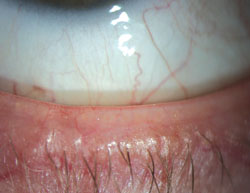 MGD spurs changes in the tear film, symptoms of eye irritation and inflammation, and dry eye.