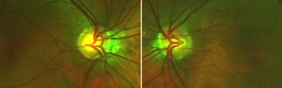 This 23-year-old man has situs inversus of the optic nerves. These Panoramic 200C images show that the central disc vessels emanate from the temporal disc area, spread nasally and then hook back temporal. Note that the nasal disc margins are blunted and there are nasal choroidal crescents in the nasally tilted discs. The patient's visual acuity was 20/25 (20/20 pinhole) in each eye. His pupils were 4.25 mm, round and 3+ reactive and had no afferent pupillary defect. Applanation tonometry was 16 mm Hg OD and 15 mm Hg OS. Cupping was 0.4 OD and 0.25 OS.