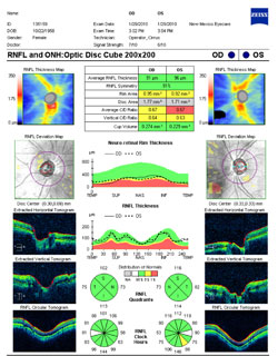 The RNFL is essentially normal, the optic disc sizes are considered average at 1.77 mm2 OD and 1.71 mm2 OS, and the symmetry is good at 91%. Note that the nasal disc margins are somewhat blunted in the nasally tilted discs.