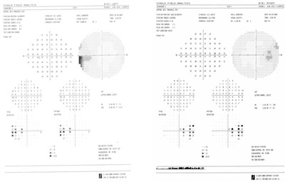 Note the bitemporal defects due to the bilateral nasal tilted discs.