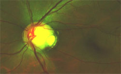 This 38-year-old woman had an optic pit in the temporal region of the optic disc, as shown in this Panoramic 200C image. During an evaluation for glaucoma, her visual acuity was found to be 20/20 in each eye. Her pupils were 4.5 mm, round and 4+ reactive, with no afferent pupillary defect. Applanation tonometry was 16 mm Hg OD and 15 mm Hg OS. Cupping was 0.55 OD and 0.8 OS.