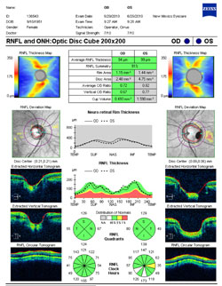 The optic disc cube scan shows a large optic disc of 4.75 mm2 with the pit. The other optic disc is a little larger than average (1.8 mm2) at 2.48 mm2.