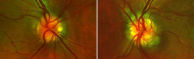 These Panoramic 200C images (Optos, Marlborough, Mass.) show optic disc drusen in the left eye more than the right in a 23-year-old man. His visual acuity was 20/25 (20/20 pinhole) in each eye; pupils were 4.25 mm, round, 3+ reactive; and there was no afferent pupillary defect. Applanation tonometry was 16 mm Hg OD and 15 mm Hg OS. There was no cupping in either eye.