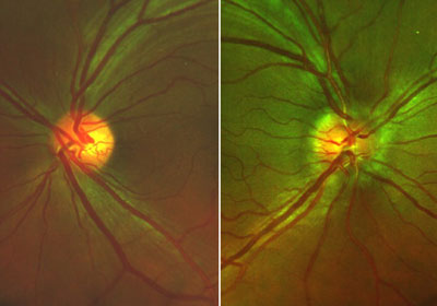 Acute optic neuritis is seen in the right eye of this 41-year-old woman with Panoramic 200C. Note the small cup in the right eye as compared to the left eye and the indistinct disc margins and dilated veins. Upon evaluation for optic neuritis, her visual acuity was found to be 20/50 (20/40 pinhole) OD and 20/25 (20/20- pinhole) OS. Her pupils were 6.5 mm, round and nonreactive (dilated). Tonometry was 10,11 mm Hg OD and 11,11 mm Hg OS with applanation.