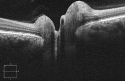 This OCT line scan shows elevation of the optic nerve head.