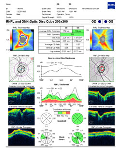 This RNFL and optic nerve head scan show that the optic nerve and the adjacent retina are swollen.