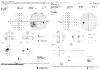 Humphrey visual field test shows defects in the right eye.