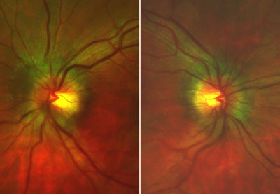 These Panoramic 200C images show bilateral papilledema in a 17-year-old female. Note the indistinct disc margins and dilated veins. The patient was sent for evaluation of papilledema due to pseudotumor cerebri. Her visual acuity was 20/20 in each eye. Her pupils were 7 mm, round and nonreactive (dilated). Noncontact tonometry was 11 mm Hg OD and 15 mm Hg OS. Cupping was 0.35 OD and 0.3 OS.