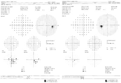 Humphrey visual field test shows central defects greater in the right eye than the left.