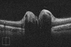 Optic disc drusen. Note the dramatic elevation to the nerve head.