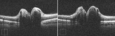 OCT line scans show buried drusen and elevated optic nerve heads.