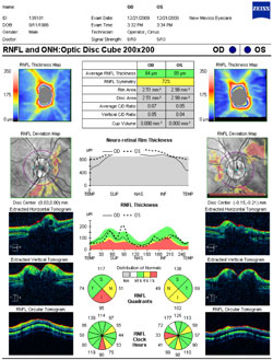 Retinal nerve fiber layer scans show retinal nerve fiber thickness in all the colors with some thinning of RNFL due to atrophy of neurons from local compression of the drusen. There is a marginal degree of symmetry of 72% due to the unequal loss of neurons in each eye. Note that the disc area is 2.51 mm2 OD and 2.98 mm2 OS, which is larger than the average size of 1.80 mm2. This is due to the lateral expansion of the nerves from the space-occupying drusen.