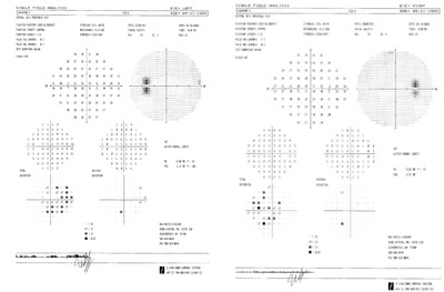 Humphrey visual fields (Carl Zeiss Meditec) show enlarged blind spots. 