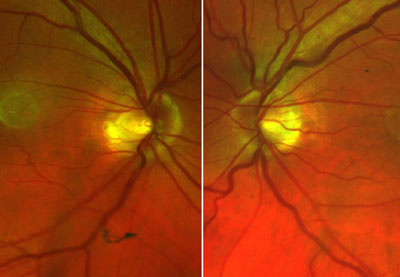 This 67-year-old man had a temporal tilted disc with temporal choroidal crescents. These Panoramic 200C images show the blunted temporal margins of the disc and a floater inferior to the right optic disc. His visual acuity was 20/20 in each eye. Intraocular pressure was 15 mm Hg OD and 15 mm Hg OS. His pupils were 3 mm, round and 4+ reactive with a negative afferent pupillary defect. Optic disc cupping was 0.4 V X 0.45 H in each eye, but this is difficult to measure due to the tilting of the optic discs. The patient had normal Humphrey visual fields.