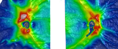 These images show temporal tilted discs with truncation of the temporal disc margin. The choroidal crescent can be seen at the small blue area just temporal to the discs. The inferior narrow arc of dark blue is an artifact from the failure of the scan to find the RPE layer and, thus, is represented as a thinner area of retina.