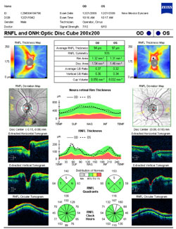 The RNFL appears to be essentially normal, the optic disc sizes are small at 154 um OD and 146 um OS (tilted discs are usually small in area), and the symmetry is good at 93%.