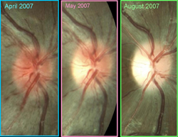 Typical optic disc appearance in LHON. A 15-year-old male with a family history of LHON (mt 11778) presented with no symptoms in April 2007. 